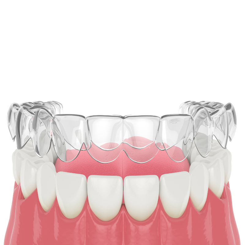 types of retainers essix retainers