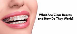 What Are Clear Braces and How Do They Work?